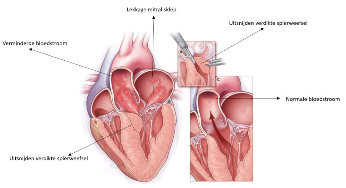 Hypertrofische Obstructieve Cardiomyopathie (HOCM) - Thorax Centrum Twente